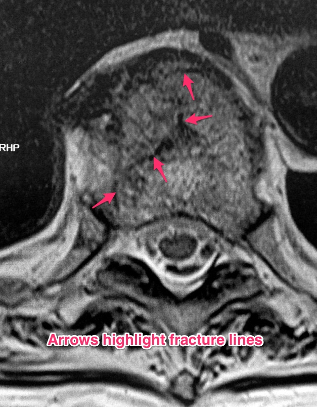 Prednisone as a cause of Back Pain