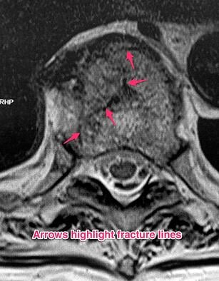 MRI Thoracic spine (transverse)