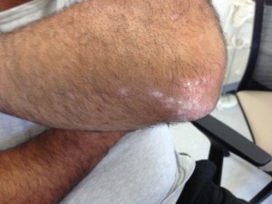 Psoriasis on the elbow