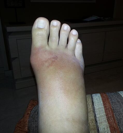 Swollen foot