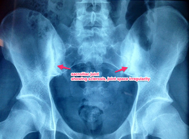 Xray of Sacroiliac Joints - Grade 3 sacroiliitis