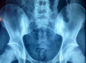 Sacroiliitis