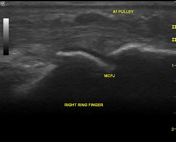 Ultrasound (longitudinal view) of a trigger finger