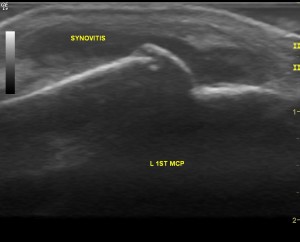 1st MCP joint (hand) showing active disease