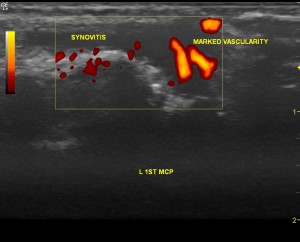 Now in power doppler mode. Showing abnormal blood vessels, signalling active inflammation.
