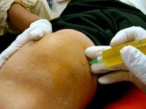 Joint Aspiration Joint Aspiration