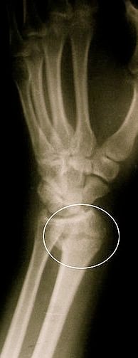 Colles Fracture