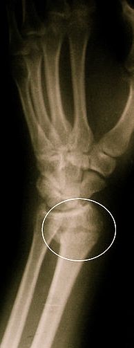 Colles Fracture