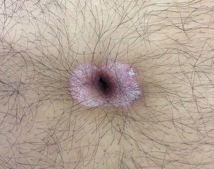 Psoriasis at Umbilicus