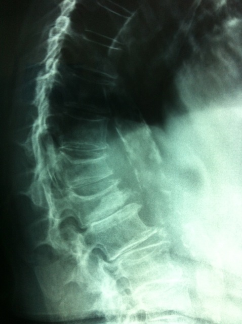 Vertebral fracture