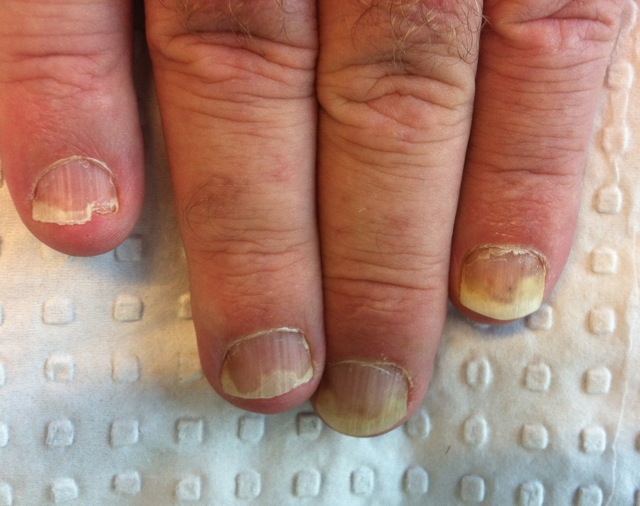 People with Nail Psoriasis May Have a Higher Chance of Developing PsA