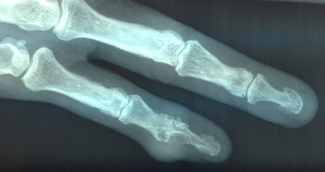 Tophus with underlying joint destruction