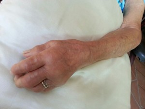 Hand Swelling
