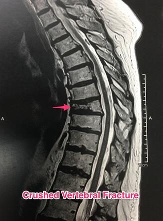 MRI thoracic spine (sagittal)