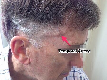 Temporal Arteritis