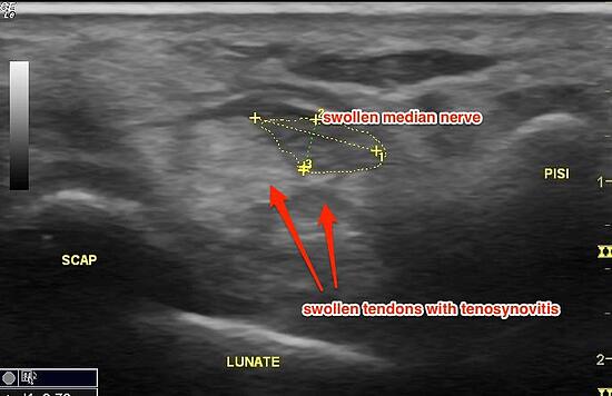 Ultrasound Image: Cross-section of Carpal Tunnel. (SCAP = scaphoid, PISI = pisiform)