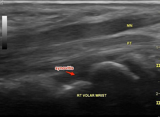 Ultrasound Image: Longitudinal view (MN = median nerve, FT = flexor tendon)