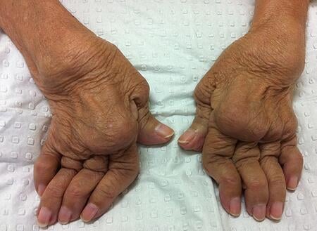 Rheumatoid Hands: late disease