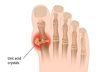 Uric-Acid
