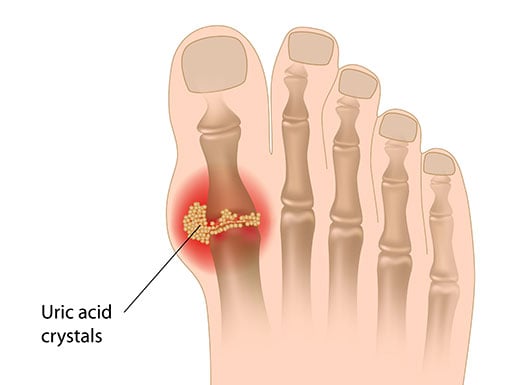 Uric-Acid.jpg