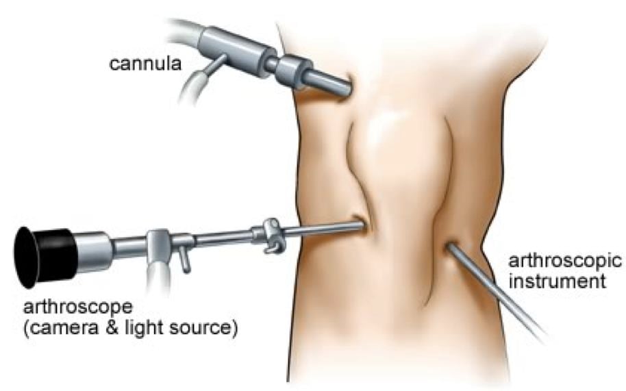 Arthroscopy.jpg