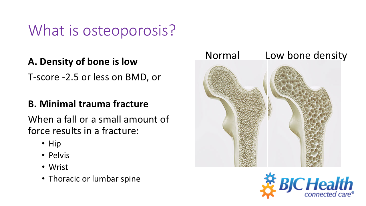 two images showing the inside of a bone, one normal and one low density. Also contains text reading "A. Density of bone is low. T-score of -2.5 or less on BMD, or B. Minimal trauma fracture: when a fall or small amount of force results in a fracture in hip, pelvis, wrist, or thoracic/lumbar spine"
