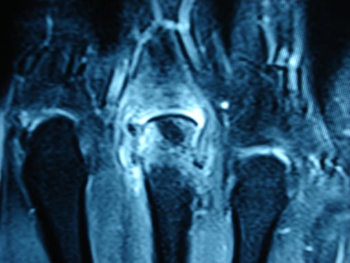 MRI 3rd MCP joint