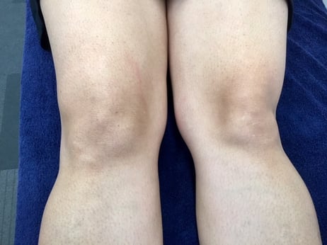 Knee Effusion 2.jpg