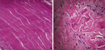 Normal Tendon Structures vs Tendinopathy