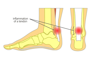 inflammation of a tendon