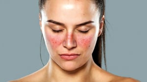 lupus-rash