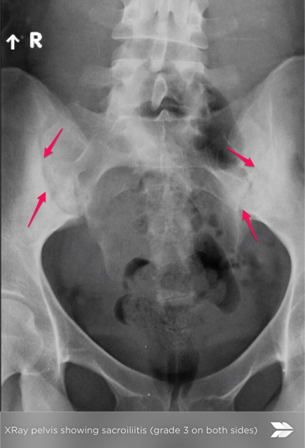 Sacroiliac X-rays in of Ankylosing